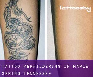 Tattoo verwijdering in Maple Spring (Tennessee)