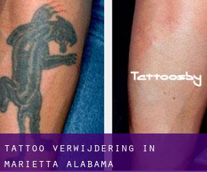 Tattoo verwijdering in Marietta (Alabama)