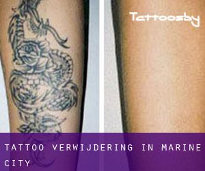 Tattoo verwijdering in Marine City