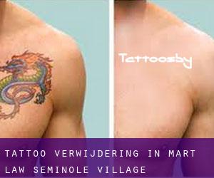Tattoo verwijdering in Mart Law Seminole Village