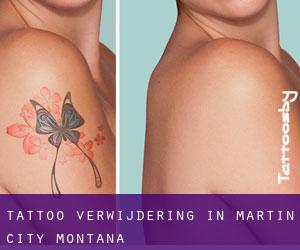 Tattoo verwijdering in Martin City (Montana)
