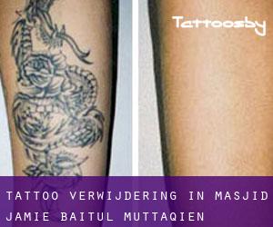 Tattoo verwijdering in Masjid Jamie Baitul Muttaqien