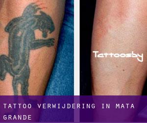 Tattoo verwijdering in Mata Grande