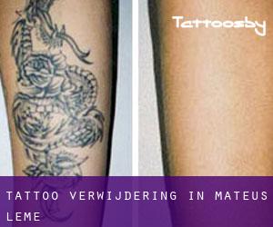 Tattoo verwijdering in Mateus Leme