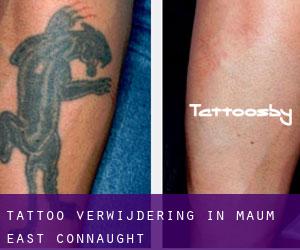 Tattoo verwijdering in Maum East (Connaught)