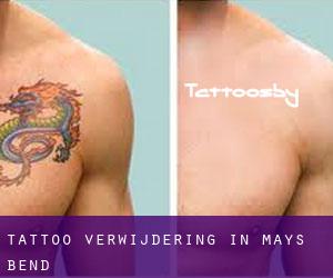 Tattoo verwijdering in Mays Bend