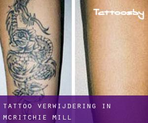 Tattoo verwijdering in McRitchie Mill