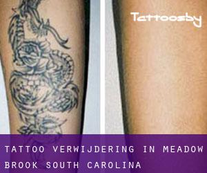 Tattoo verwijdering in Meadow Brook (South Carolina)