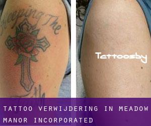 Tattoo verwijdering in Meadow Manor Incorporated