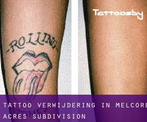 Tattoo verwijdering in Melcore Acres Subdivision