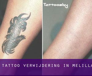 Tattoo verwijdering in Melilla