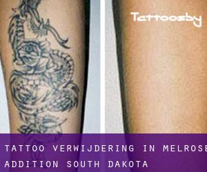 Tattoo verwijdering in Melrose Addition (South Dakota)