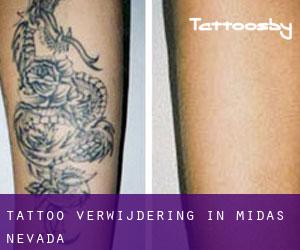 Tattoo verwijdering in Midas (Nevada)