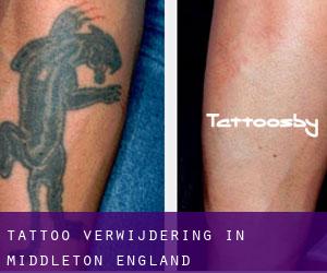 Tattoo verwijdering in Middleton (England)