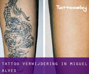 Tattoo verwijdering in Miguel Alves