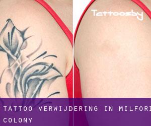 Tattoo verwijdering in Milford Colony