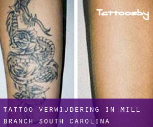 Tattoo verwijdering in Mill Branch (South Carolina)