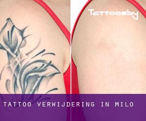 Tattoo verwijdering in Milo