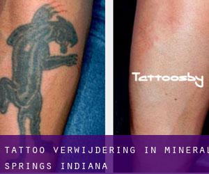 Tattoo verwijdering in Mineral Springs (Indiana)