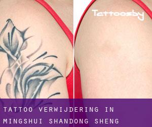 Tattoo verwijdering in Mingshui (Shandong Sheng)