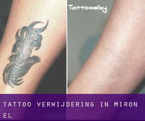 Tattoo verwijdering in Mirón (El)