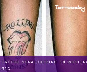 Tattoo verwijdering in Moftinu Mic