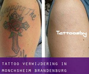 Tattoo verwijdering in Mönchsheim (Brandenburg)