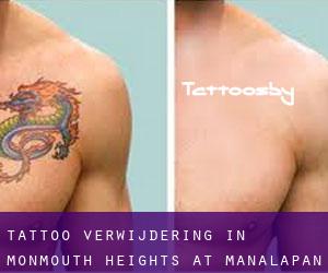 Tattoo verwijdering in Monmouth Heights at Manalapan