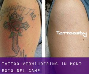 Tattoo verwijdering in Mont-roig del Camp
