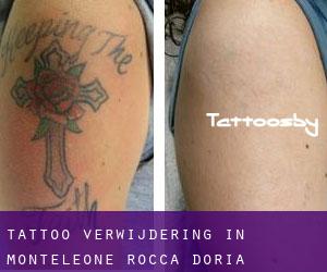 Tattoo verwijdering in Monteleone Rocca Doria