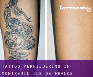Tattoo verwijdering in Montreuil (Île-de-France)