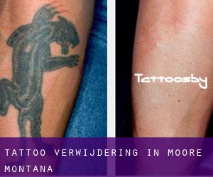Tattoo verwijdering in Moore (Montana)
