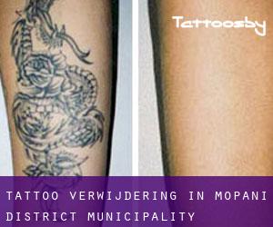 Tattoo verwijdering in Mopani District Municipality
