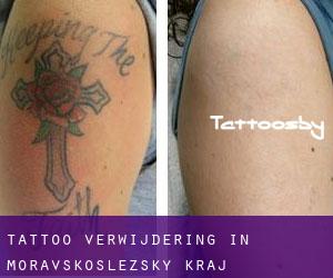 Tattoo verwijdering in Moravskoslezský Kraj