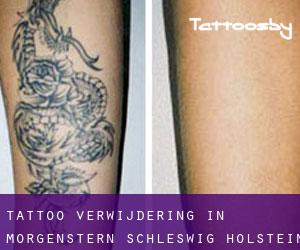 Tattoo verwijdering in Morgenstern (Schleswig-Holstein)