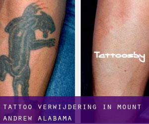 Tattoo verwijdering in Mount Andrew (Alabama)
