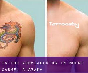 Tattoo verwijdering in Mount Carmel (Alabama)