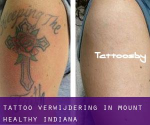 Tattoo verwijdering in Mount Healthy (Indiana)