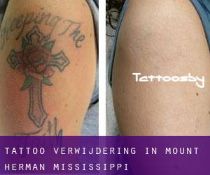 Tattoo verwijdering in Mount Herman (Mississippi)