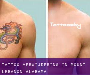 Tattoo verwijdering in Mount Lebanon (Alabama)