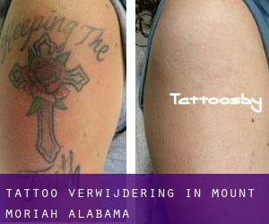 Tattoo verwijdering in Mount Moriah (Alabama)