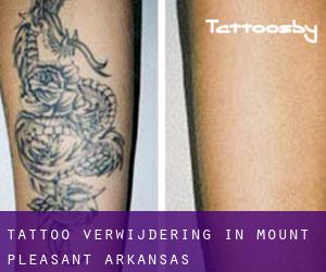 Tattoo verwijdering in Mount Pleasant (Arkansas)