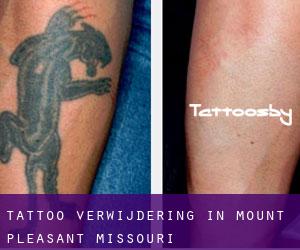 Tattoo verwijdering in Mount Pleasant (Missouri)