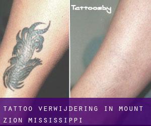 Tattoo verwijdering in Mount Zion (Mississippi)
