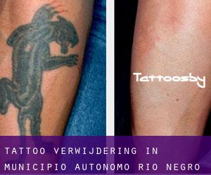 Tattoo verwijdering in Municipio Autónomo Río Negro
