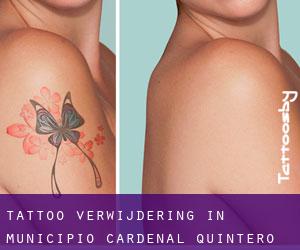 Tattoo verwijdering in Municipio Cardenal Quintero