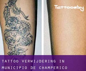 Tattoo verwijdering in Municipio de Champerico