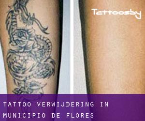Tattoo verwijdering in Municipio de Flores