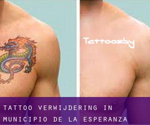 Tattoo verwijdering in Municipio de La Esperanza