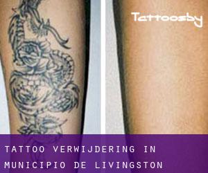 Tattoo verwijdering in Municipio de Lívingston